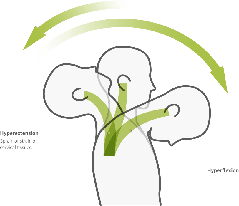 Whiplash Injurie Whiplash Injurie