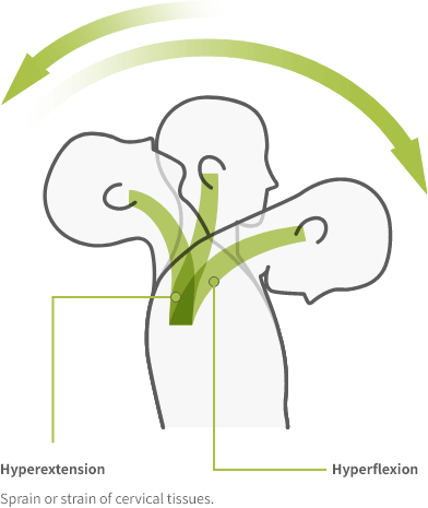Whiplash Injurie Whiplash Injurie